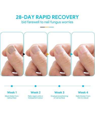 Nail Fungus Cleaning Laser Device Anti Fungal Laser Nail Fungus Laser Treatment with Time Display for Damaged Discolored Thick Toenails & Fingernails Nail Therapy for Onychomycosis Easy to Use at H - Buy Online on GoSupps.com