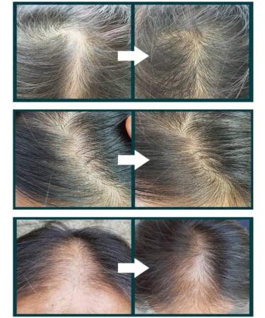 WHITESILK (100ml) THE SCM 85 (human stem cell) + HGF Therapy Anti-Hair Loss Hair Scalp EXPERT Serum Promotes Growth and Lessens Hair Loss with SCM-3D Biomimetic Technology - Buy Online on GoSupps.com