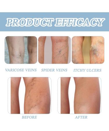 Seaweed Cream Against Varicose Veins Seaweed Cream Against Varicose Veins Cream Against Varicose Veins Refreshing and Relaxing Swollen and Tired Legs for All Skin Types - Buy Online on GoSupps.com