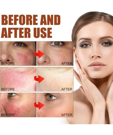 Rosacea Face Serum Face Serum Hyaluronic Acid Face Oil Anti-Aging Relieve Redness &Quick Repair Damage Skin Niacinamide Serum Replumps & Hydrates Collagen Face Serum-Protect Skin+Reduce Acne-Women 1 - Buy Online on GoSupps.com