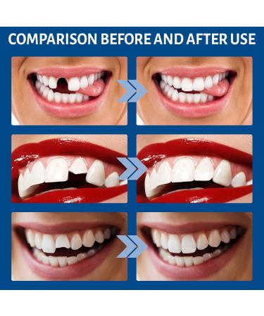 Provisional Denture Adhesive Set | Temporary Dental Repair Kit & Instant Veneers for Provisional Teeth - Buy Online on GoSupps.com