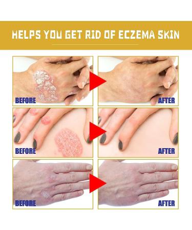Professional Psoriasis Treatment Cream with New Zealand Bee Venom - Soothing & Moisturizing Formula - 5PCS - Buy Online on GoSupps.com