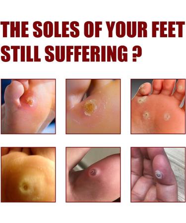 10ml Extra Strength Foot Corn Removal Gel | Callus Remover for Feet | Corn Removers Gel - 1pcs - Buy Online on GoSupps.com