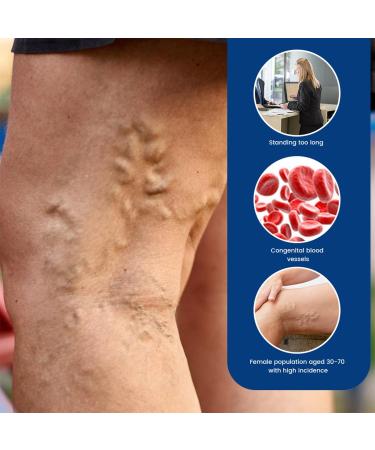  MagiSel Varicose Vein Cream Cream Against Spider Veins Varicose Vein Leg Care Cream 20g Spider Vein Varicose Vein Cream for Legs Eliminates Varicose Veins and Spider Veins - Buy Online on GoSupps.com