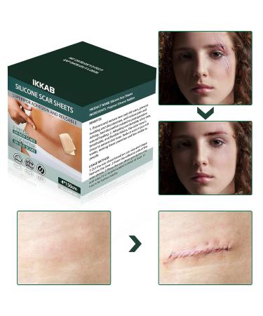 IKKAB Silicone Scar Sheets - Reusable Effective Scar Removal Tape for Surgical Scars, Keloids, C-Section, Tummy Tuck - 1.6 x 60 Roll - Buy Online on GoSupps.com