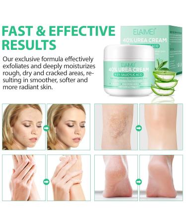 Urea Cream 40% with 2% Salicylic Acid - Best Callus Remover & Foot Repair Lotion for Dry Cracked Heels Knees & Hands (5.29 OZ) - Deep Moisturization & Skin Renewal - International Shipping Available - Buy Online on GoSupps.com