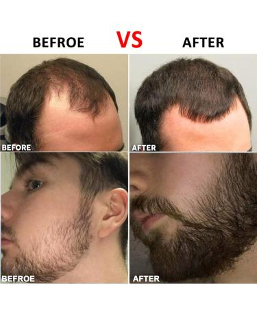 Buy LacyMC 0.5mm Dermaroller - Microneedling Roller for Skin & Hair Care | Face & Body Homecare Set - Buy Online on GoSupps.com