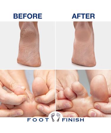 Foot Finish Athlete's Foot Treatment Cream - 4oz | Natural Anti-Itch Relief for Dry Cracked Feet with Tea Tree, Rose & Lavender Oil - Buy Online on GoSupps.com