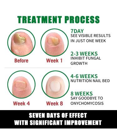 Ginger Nail Treatment & Care | 7-Day Nail Growth Serum & Cuticle Oil for Healthy Nails - Buy Online on GoSupps.com