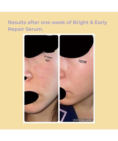 Evre Bright & Early Teen Vitamin C Repair Serum Brightens Hydrates & Evens Skin Tone Natural Cruelty-Free & Palm-Free Great for Sensitive Skin 1 Fl Oz - Buy Online on GoSupps.com