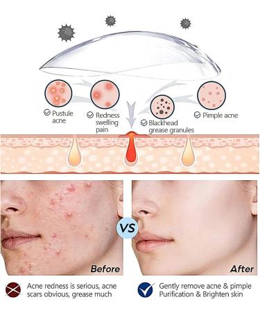 Dark Spot Remover for Face and Body Freckle Removel Cream Pigmentation Removal Melasma Cream Dark Spot Corrector Dark Spot Remover for Face Age Spot Remover for Face Dark Age Spot Remover - Buy Online on GoSupps.com