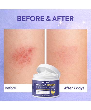 Dr. Luke Manuka Honey Wound care: Medihoney Wound Gel for Minor wounds & Skin Repair - Manuka Honey Medical Grade with Akkantoin 0.5% & Vitamin E - 2.82 oz (80g) - Buy Online on GoSupps.com