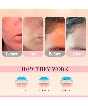 Pimple Patches by Glacia 240 Pack of Hydrocolloid Patches Spot Patches for All Skin Types Spot Stickers Acne Patch Made With Natural Oils Tea Tree and Calendula For Fast Acting Skincare 240 count (Pack of 1) - Buy Online on GoSupps.com