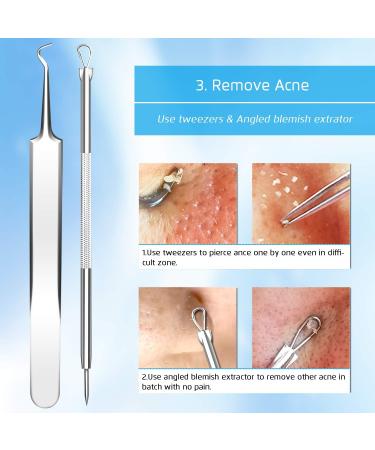 Premium Blackhead Remover & Acne Extractor Set - 5 Piece Precision Tweezers for Pimple, Whitehead & Milia Removal - Buy Online on GoSupps.com