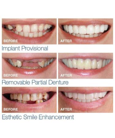 2 Pairs of Instant Veneers Dentures - Temporary False Teeth for Whitest Smile | Cosmetic Above & Below Tooth Covers - Buy Online on GoSupps.com