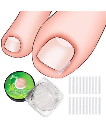 RMISODO 60 Pieces Ingrown Toenail Corrector Strips  Professional Toenail Correction Patches  Curved Toenails Straightening Recover Clips  Thick Paronychia Correction Pedicure Tool for Foot Care
