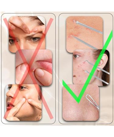 Buy SWTYEXT 10-Piece Blackhead Remover Tool Set - Stainless Steel Comedone Squeezer for Men & Women - Effective Pimple Press Tools in Box - Buy Online on GoSupps.com