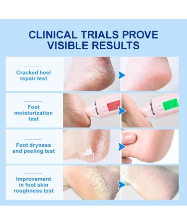 42% Urea Foot Cream 2% Acids Foot Cream For Cracked Heels And Dry Skin Foot Moisturiser Foot Cream For Hard Skin Urea Cream Soften Cracked Heel Cream Heel Balm For Foot And Body Care - Buy Online on GoSupps.com