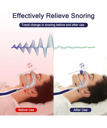 Adjustable Anti-Snoring Device for Men and Women - Stop Snoring with Nasal Dilator Nose Vents Plugs - Buy Online on GoSupps.com