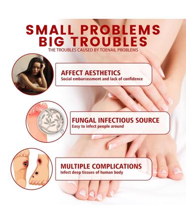 Foot Corn Remover Gel - Effective Foot Corn Removal Treatment for Cracked, Dead Dry Skin - Fits All Foot Sizes (3 pcs) - Buy Online on GoSupps.com