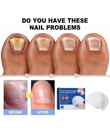 Pack of 2 Nail Care Device Therapy Nail Fungus Laser Therapy The Revolutionary and Highly Effective Light Therapy for Treating Toenail Diseases Cleaning and Care of Nails - Buy Online on GoSupps.com
