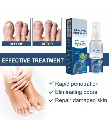 Furzero Nail Fungus & Athlete's Foot Treatment Spray - Medical Grade Anti-Itch Relief (3pcs) - Buy Online on GoSupps.com