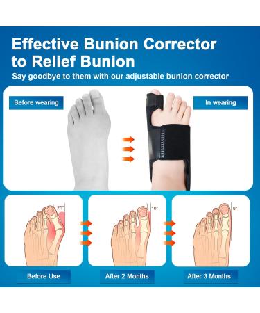 Buy Bunion Splints 03 Effective Relief & International Shipping | Your Store Name - Buy Online on GoSupps.com