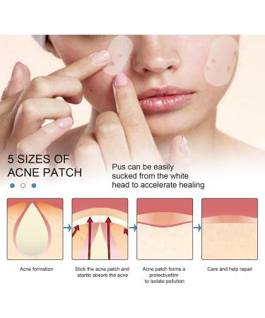 Buy Ikasus Acne Patch - 80 Hydrocolloid Pimple Dots with Tea Tree & Calendula Oil | Invisible Acne Absorbing Covers - 5 Sizes for Face & Body - International Shipping Available - Buy Online on GoSupps.com