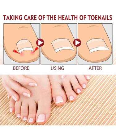 Ingrown Toenail Treatment Correction Drops Nail Growth Treatment Nail Care Ingrowing Toenail Treatment Ingrown Toenail Corrector Treatment for Ingrown Toenail Ingrowing Toenail Improve Toenail Health - Buy Online on GoSupps.com