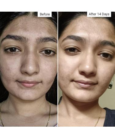 Renew Gentle Skin Cleanser with Salicylic Acid for Acne Prevention - 100 ml | International Shipping Available - Buy Online on GoSupps.com