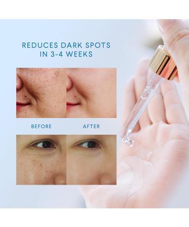 Dark Spot Remover for Face & Body | Kojic Acid Dark Spot Corrector Serum for Women & Men - 1 FL OZ - Buy Online on GoSupps.com