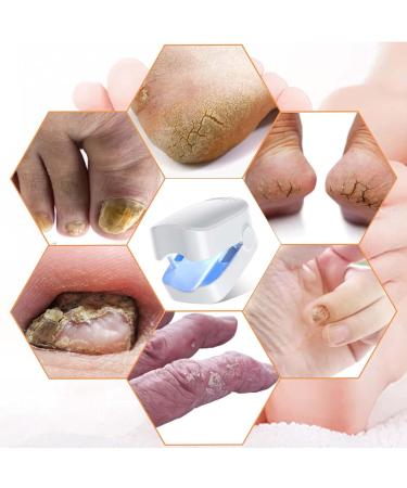 Rechargeable Nail Fungus Treatment Device - Effective Light Therapy for Onychomycosis & Portable Cold Laser Care - Buy Online on GoSupps.com