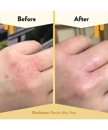 Organic ECZEMA HONEY Nut-Free Skin-Soothing Cream - Natural Hand & Body Relief for Dry, Itchy Skin - 4 Oz - Buy Online on GoSupps.com