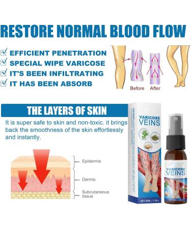 Spray de Traitement des Varices Spray apaisant pour Les Varices Kit Naturel d limination des Varices Am liorer la Circulation Sanguine pour Les Femmes et Les Hommes - Buy Online on GoSupps.com