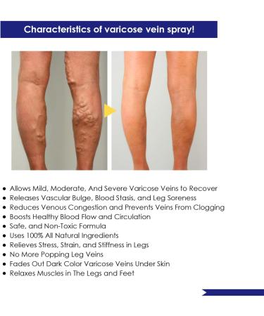 Xiyinli 30 ml Non-Toxic Varicose Vein Spray Relieves Swelling & Pain Improves Circulation - Buy Online on GoSupps.com