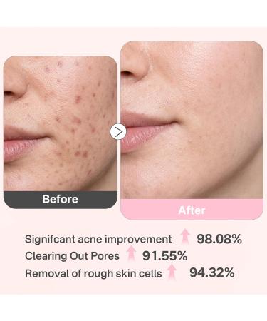 Glycolic Acid 20% Resurfacing Pads (50 Count), Exfoliating Peel Pads for Face, Skin Pore Resurfacing & Radiance, Exfoliating Toner Facial Pads with Oil, Salicylic Acid & Vitamins E, B3, B5 Pink 50 Count (Pack of 1) - Buy Online on GoSupps.com