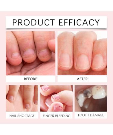 Anti Nail Biting Polish - Nail Biting Prevention - Healthy Ingredient Formula Stop Biting Nails Treatment - Bitter Taste Clear Polish for Stop Nail Biting and Thumb Sucking - Buy Online on GoSupps.com