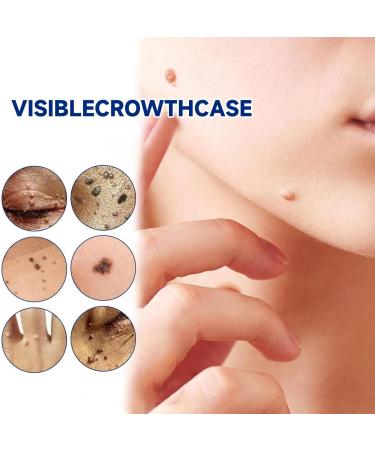  MagiSel Resistant Warts for Hands & Feet Anti-Wart and Anti-Stain Cream Anti-Wart Moisturizing Cream Anti-Corn Foot Descaling Wart Remover for Hands and Feet 20g - Buy Online on GoSupps.com