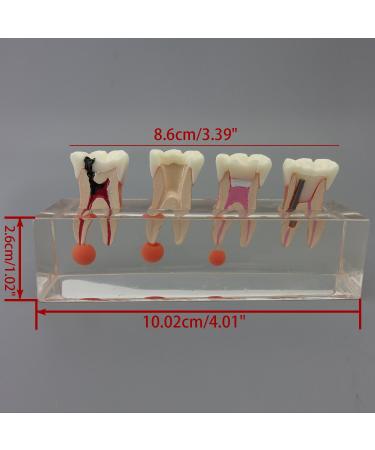 Dental Teeth Model for Endodontic Treatment - 4-Stage Teaching Aid for Studying Internationally - Buy Online on GoSupps.com