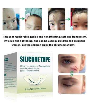 Silicone Scar Sheets 1.6 x 120 Tape Roll | Keloid & Surgical Scar Treatment | Tummy Tucks, C-Section, Burn, Acne, Stretch Marks | Wound Bandages - Buy Online on GoSupps.com