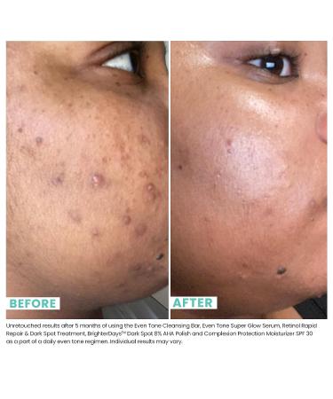 Urban Skin Rx Even Tone Super Glow Serum with Niacinamide - Brightens, Firms, and Smooths Skin | Anti-Aging Serum for Dark Spots, Sun Damage, and Wrinkles | 0.5 Fl Oz - Buy Online on GoSupps.com