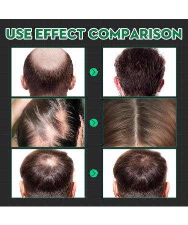 Accelerate Hair Growth Serum | Anti-Hair Loss for Men & Women | Promotes Thicker Fuller Hair - Buy Online on GoSupps.com
