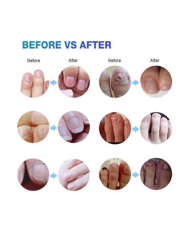 Ariella Toenail Fungus Treatment - Antifungal Nail Cure for Athletes Foot - 4pcs - Buy Online on GoSupps.com