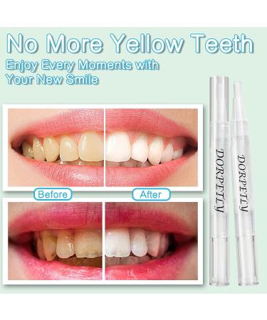 Teeth Whitening Pen Kit (4 Pcs) for Brighter Smile | Stain Remover Gel | Painless & Travel-Friendly - Buy Online on GoSupps.com