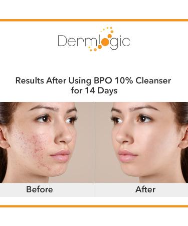 Maximum Strength Benzoyl Peroxide 10% Face & Body Wash for Acne - Clears Pores on Contact, Soothes Skin - 10 oz - Buy Online on GoSupps.com