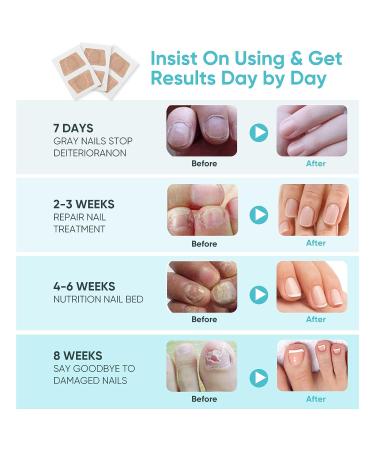 16pcs Nail Repair Strips: Extra Strength Toenail Fungus Treatment - Restore Discolored Nails - Buy Online on GoSupps.com