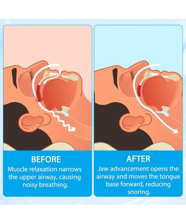 Anti Snoring Devices for Sleep Anti Snoring Mouthpiece Anti Snoring Mouth Guard Stop Sleeping Snore Snoring Solution - Buy Online on GoSupps.com