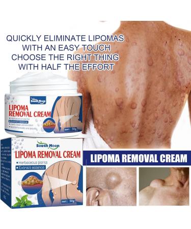 Lipoma Removal Cream Lipoma Elimination Cream Natural Herbal Lipoma Soothing Cream Effective Lipoma Care Cream Cream Relieve Varicose Veins Instant Tumor Removal Cream Skin Anti Swelling Cream - Buy Online on GoSupps.com