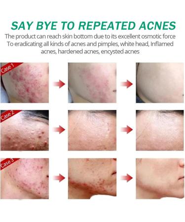 Anti Acne Face Cream Spot Cream for Acne Treatment and Spot Treatment with Nicotinamide Sodium Hyaluronate Aloe for Blackheads and Acne Prone Skin Reduces Spot Size Redness and Inflammation - Buy Online on GoSupps.com