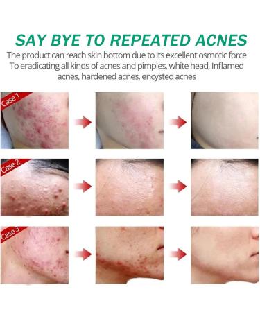 Acne Spot Treatment - Pimple Cream for Face & Body | Back Acne Solution for Teens & Adults | Reduces Redness & Size of Blemishes - Buy Online on GoSupps.com